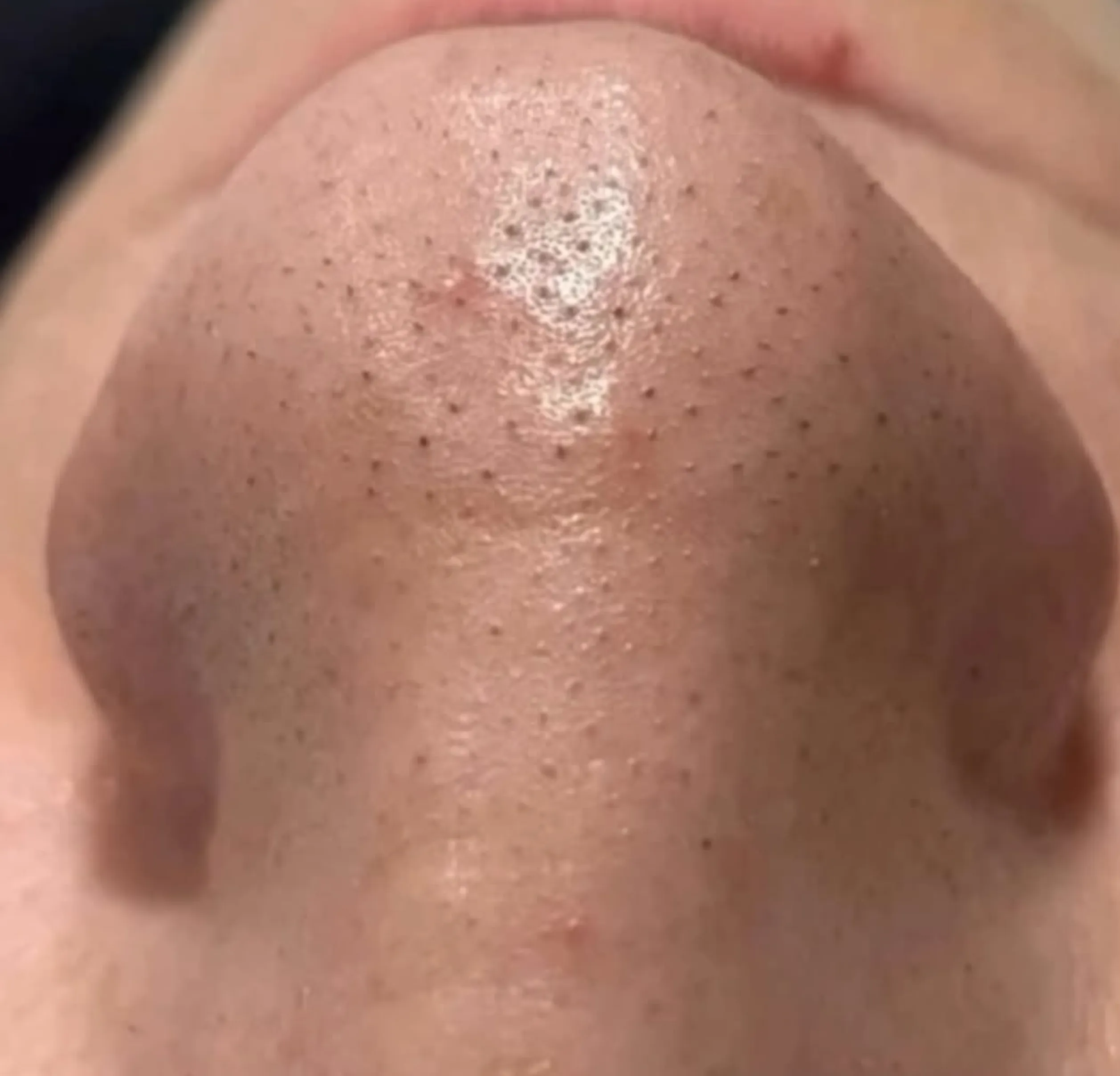acne prone skin care