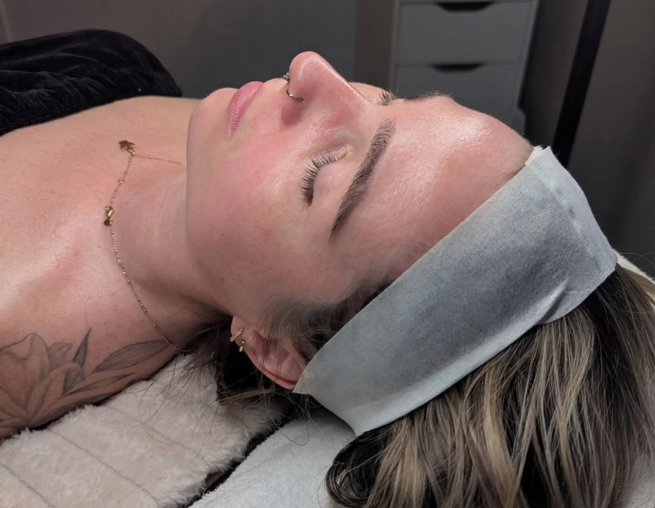 acne scar treatment options
