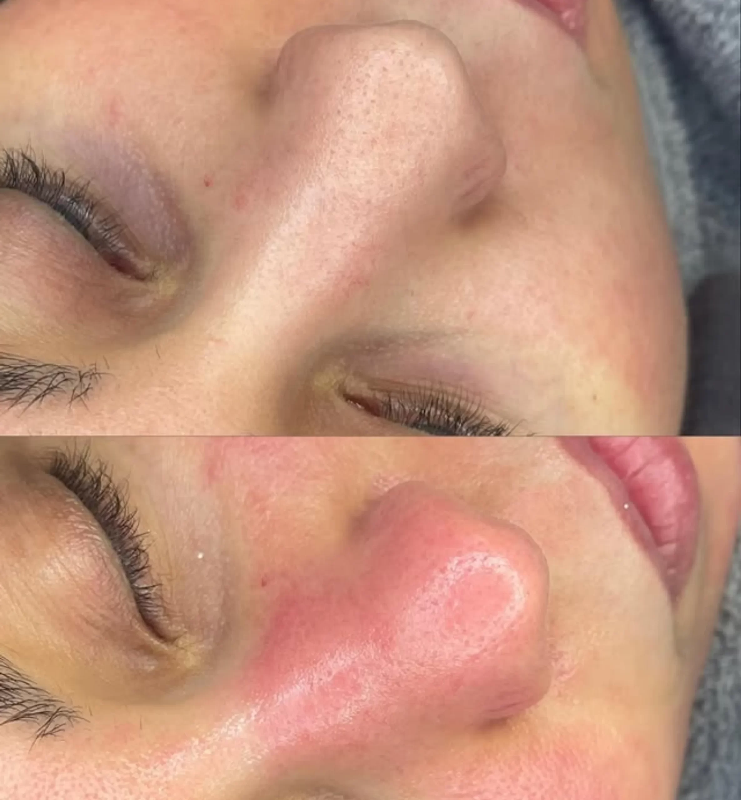 acne treatment routine
