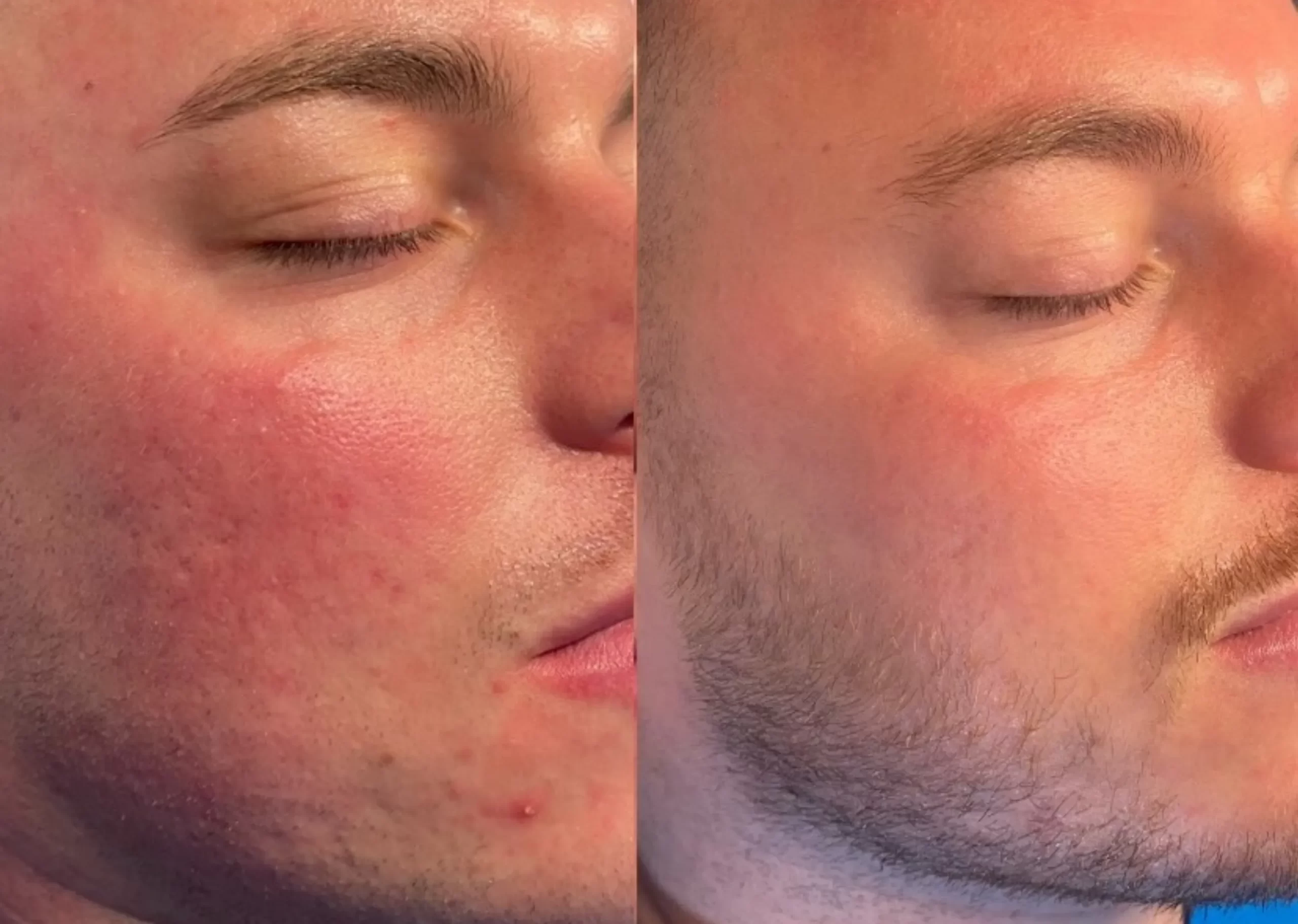 hormonal acne management